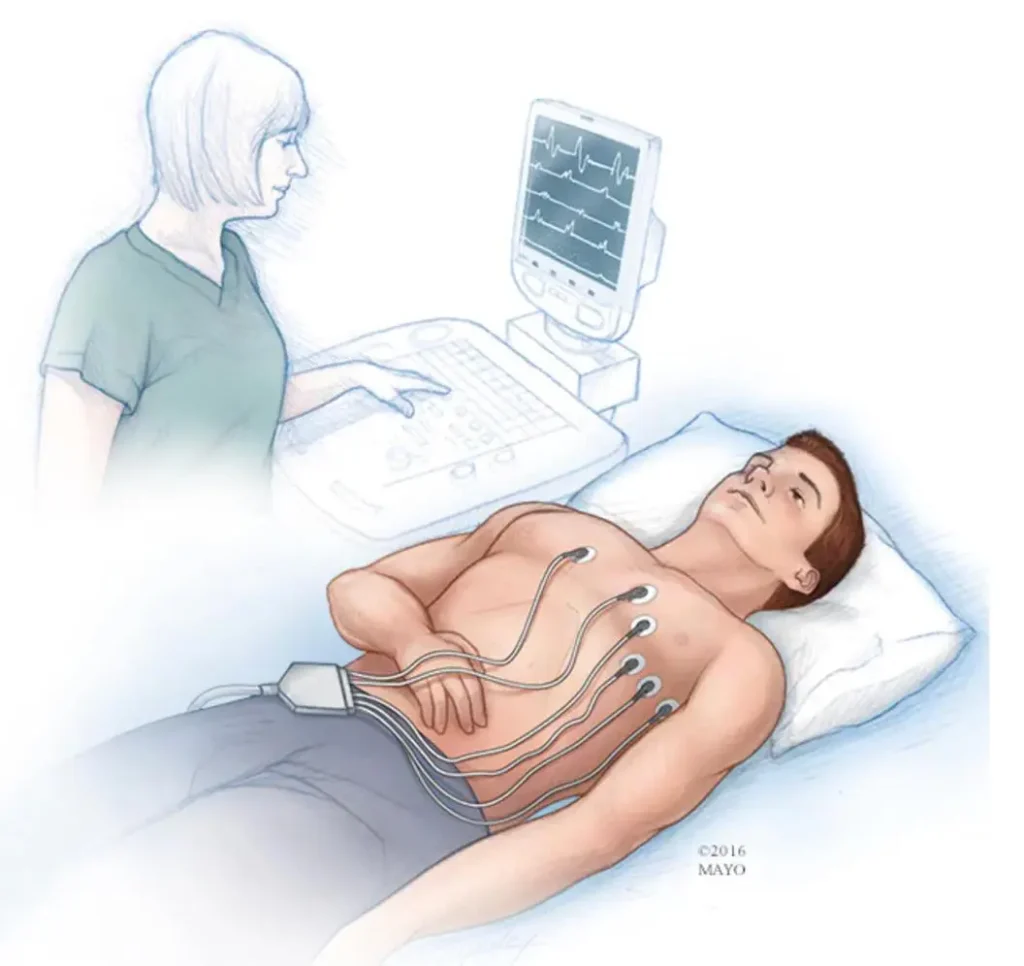 ECG