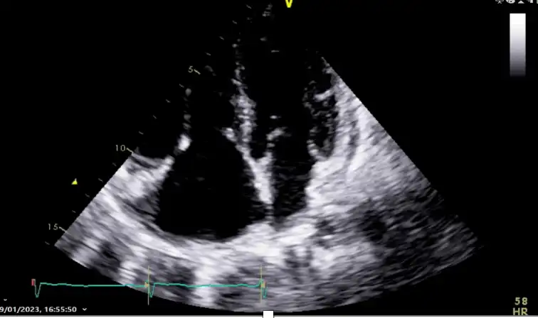 Bubble Echocardiogram