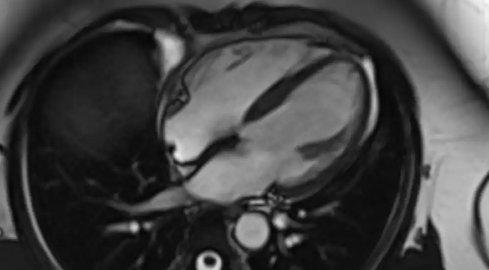 Cardiac MRI