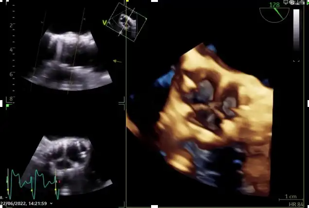 Echocardiogram